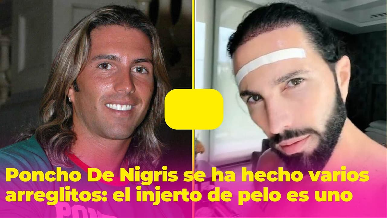Poncho De Nigris se ha hecho varios arreglitos: el injerto de cabello es sólo uno