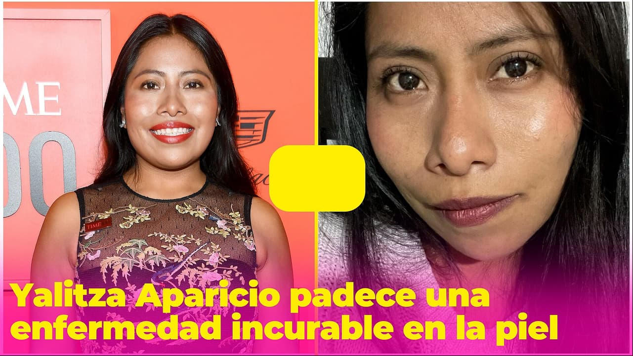 Yalitza Aparicio padece una enfermedad incurable en la piel, así la ha combatido